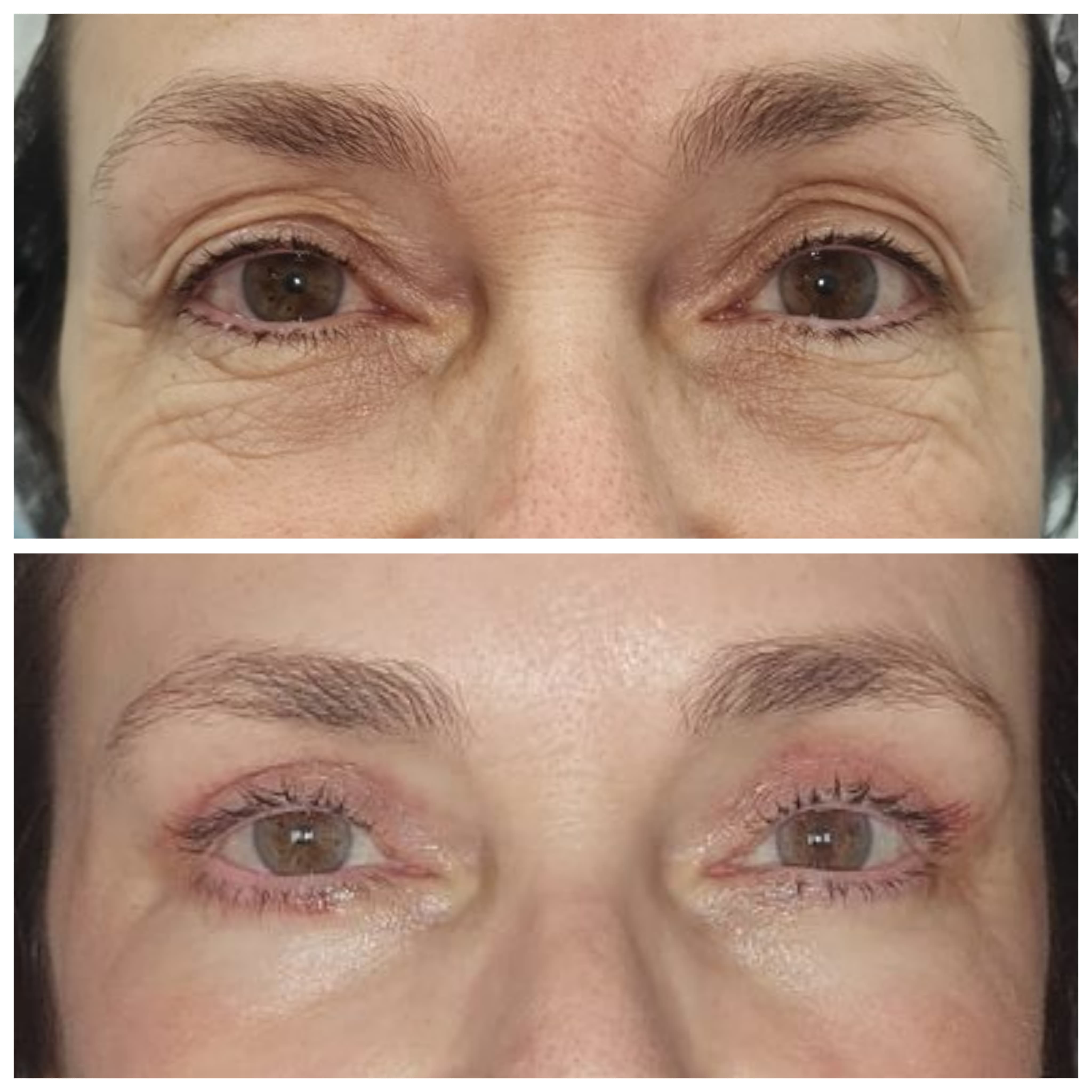 Antes e depois de blefaroplastia 1